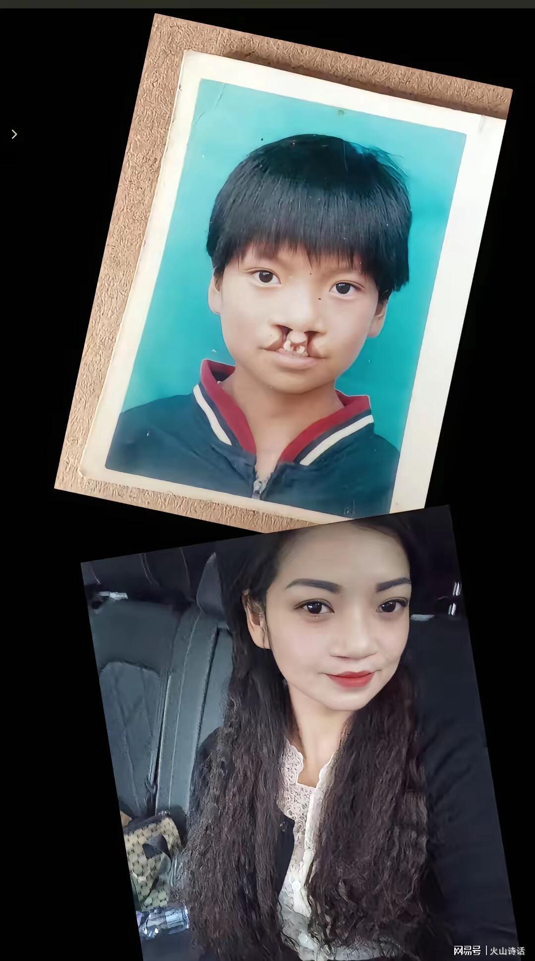 kaiyun-震惊！为声援李亚鹏，一漂亮女孩坦然展示自己唇腭裂手术前后照片